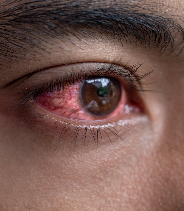 Redness or irritation in Eyes