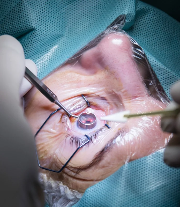 lasik Surgery