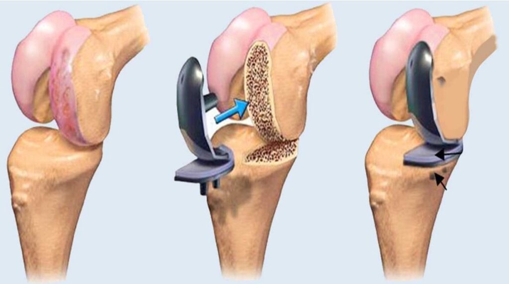 Best Joint Replacement Surgeon in Ahmedabad